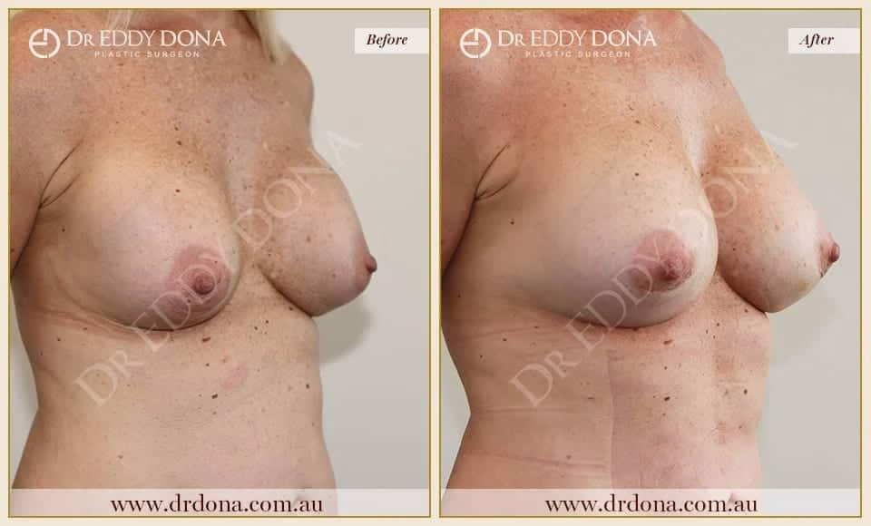 Dr Eddy Dona - Revision Breast Surgery - Before and After