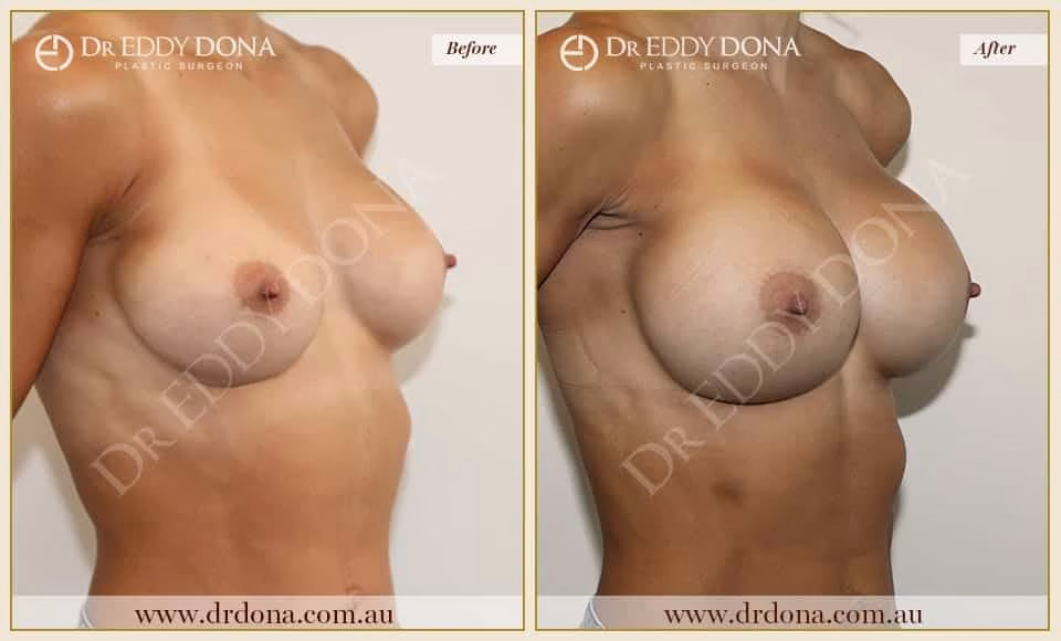 Dr Eddy Dona Breast Augmentation and Exchange of Implants Before and After