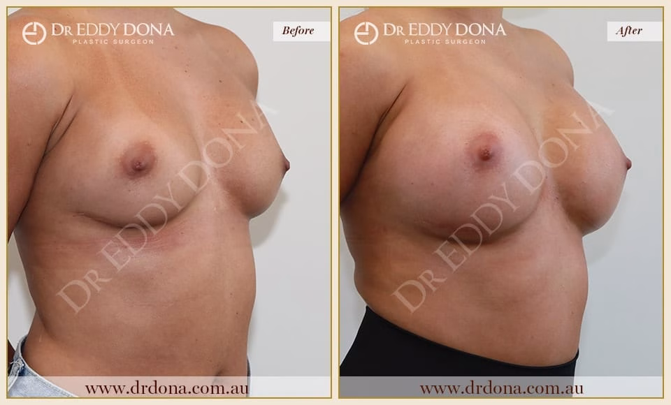 Dr Eddy Dona - Revision Breast Surgery Before and After