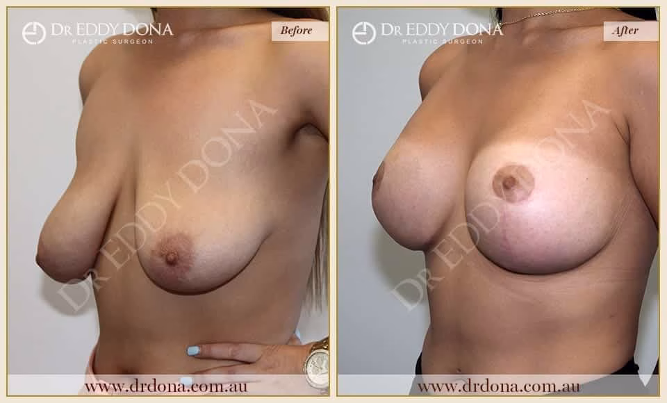 Dr Eddy Dona - Breast Lift and Implants Surgery - Before and After