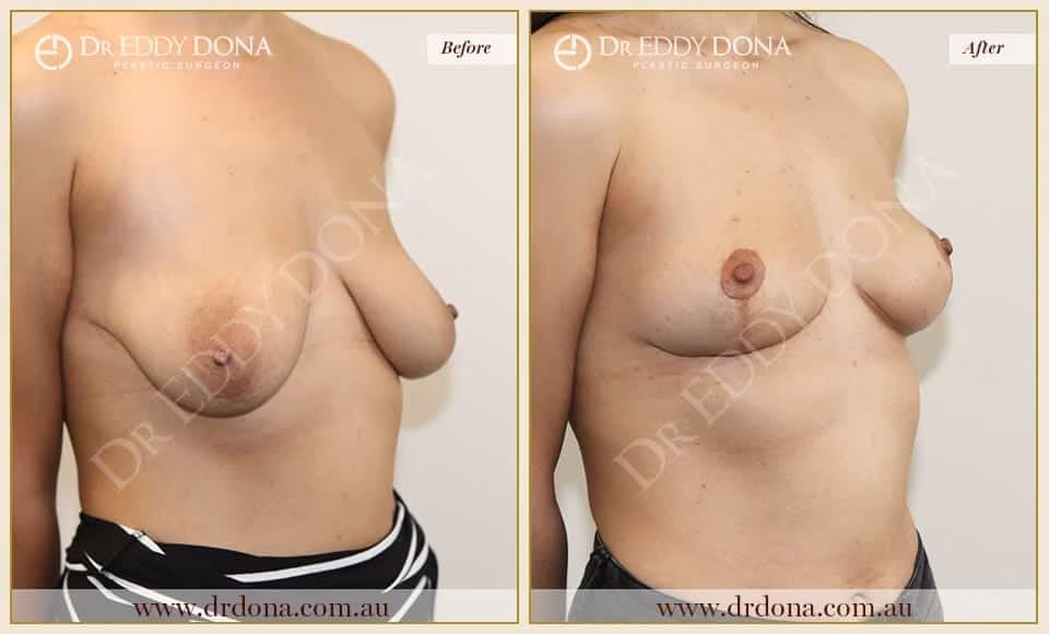 Dr Eddy Dona - Breast Lift - Before and After
