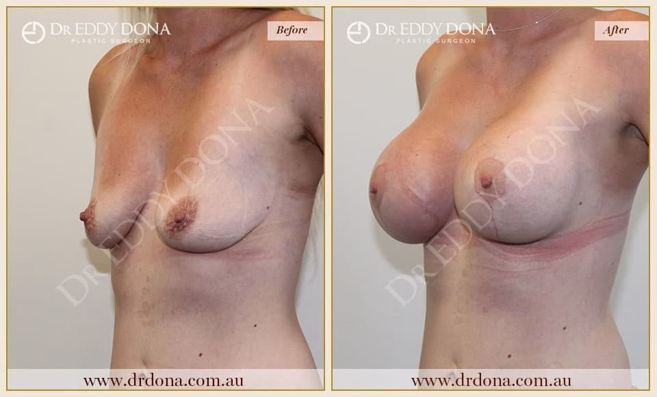 Dr Eddy Dona - Breast Lift and Implants Surgery - Before and After