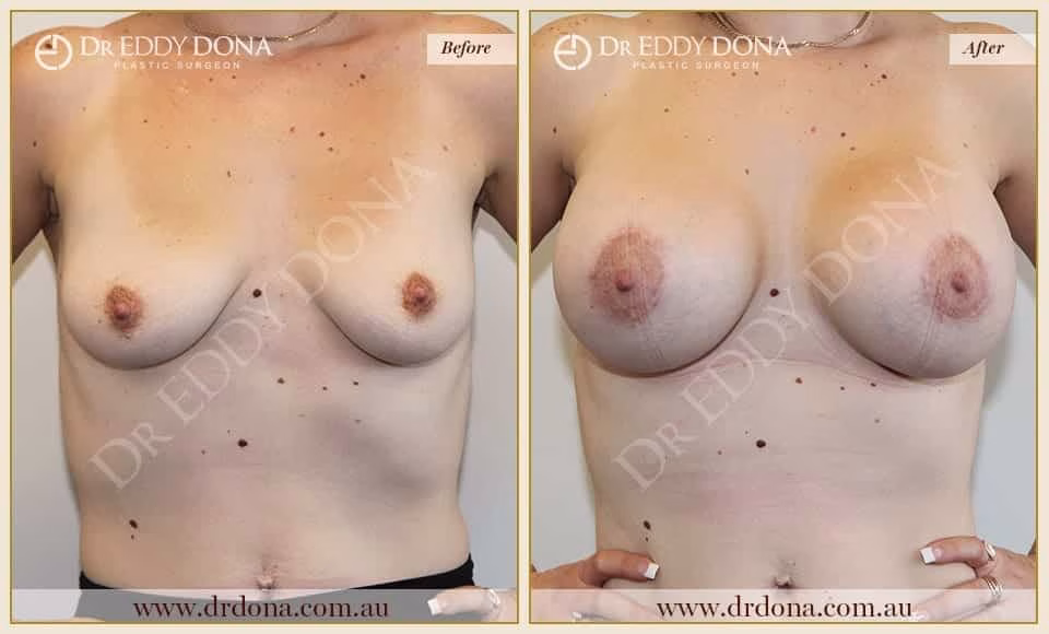 Dr Eddy Dona - Breast Lift and Implants Surgery - Before and After