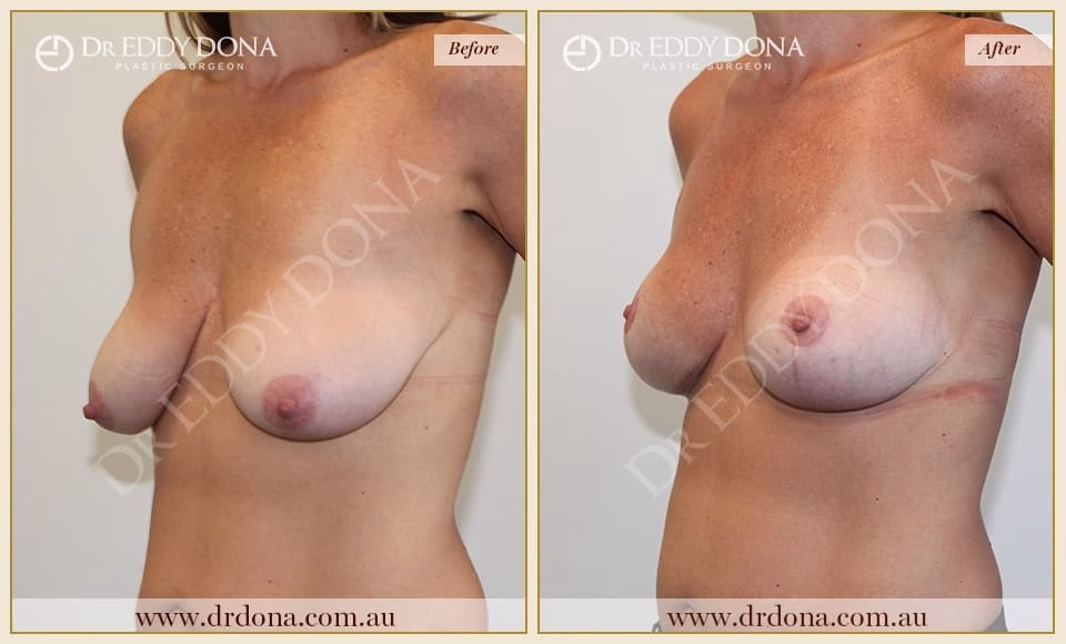 Dr Eddy Dona - Breast lift Surgery - Before and After
