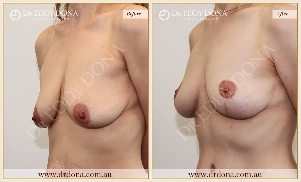 Dr Eddy Dona - Breast lift Surgery - Before and After