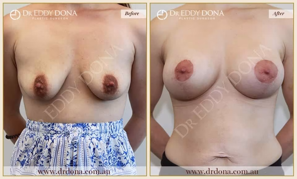 Dr Eddy Dona - Breast Lift and Implants Surgery - Before and After