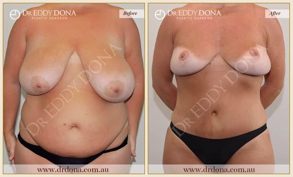 Dr Eddy Dona - Mummy Makeover Before and After Frontal