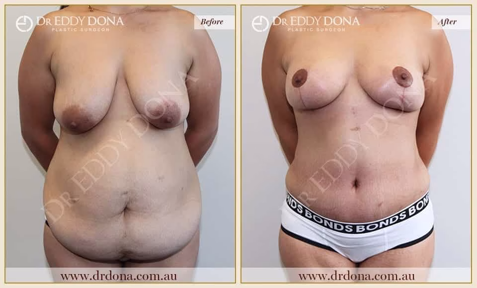 Dr Eddy Dona Before and After Mummy Makeover
