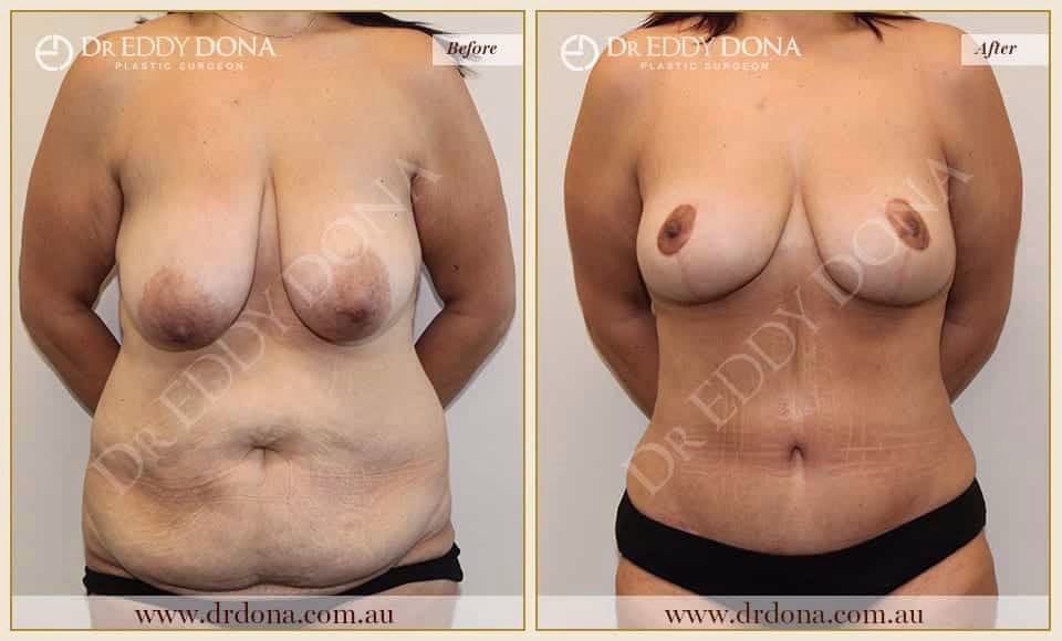 Dr Eddy Dona Before and After Mummy Makeover
