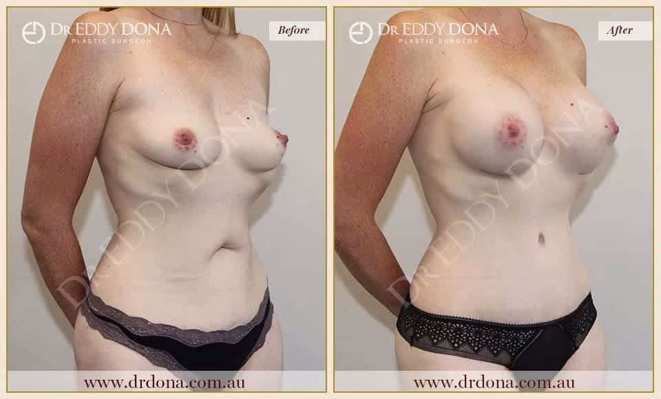 Dr Eddy Dona Before and After Mummy Makeover