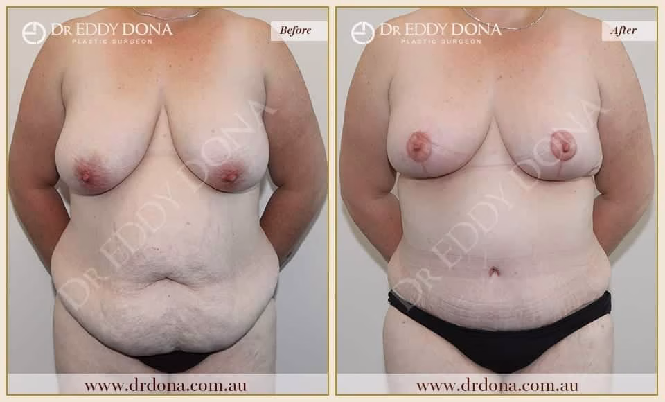 Dr Eddy Dona - Mummy Makeover - Before and After