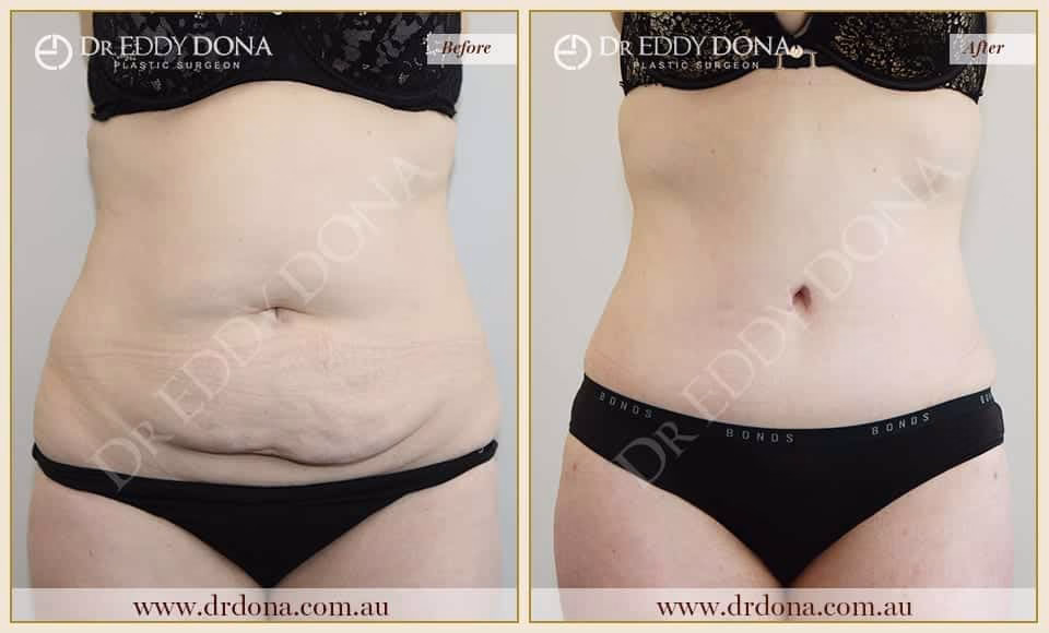 Dr Eddy Dona - Tummy Tuck - Before and After