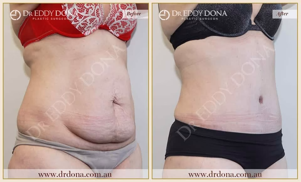 Dr Eddy Dona Plastic Surgery Tummy Tuck Before and After Right Oblique